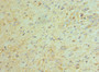 Immunohistochemistry of paraffin-embedded human glioma using CAC10571 at dilution of 1:100