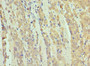 Immunohistochemistry of paraffin-embedded human colon cancer using CAC10580 at dilution of 1:100