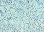 Immunohistochemistry of paraffin-embedded human breast cancer using CAC10584 at dilution of 1:100