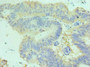 Immunohistochemistry of paraffin-embedded human colon cancer using CAC10590 at dilution of 1:100