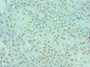 Immunohistochemistry of paraffin-embedded human breast cancer using CAC10594 at dilution of 1:100