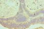 Immunohistochemistry of paraffin-embedded human colon cancer using CAC10596 at dilution of 1:100