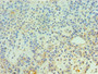 Immunohistochemistry of paraffin-embedded human breast cancer using CAC10599 at dilution of 1:100