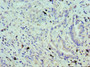 Immunohistochemistry of paraffin-embedded human lung cancer using CAC10617 at dilution of 1:100