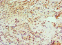 Immunohistochemistry of paraffin-embedded human breast cancer using CAC10622 at dilution of 1:100