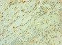 Immunohistochemistry of paraffin-embedded human breast cancer using CAC10624 at dilution of 1:100