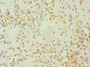 Immunohistochemistry of paraffin-embedded human breast cancer using CAC10625 at dilution of 1:100