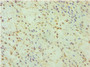 Immunohistochemistry of paraffin-embedded human breast cancer using CAC10636 at dilution of 1:100