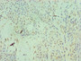 Immunohistochemistry of paraffin-embedded human breast cancer using CAC10637 at dilution of 1:100