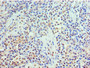Immunohistochemistry of paraffin-embedded human breast cancer using CAC10638 at dilution of 1:100