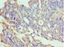 Immunohistochemistry of paraffin-embedded human endometrial cancer using CAC10638 at dilution of 1:100