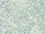 Immunohistochemistry of paraffin-embedded human breast cancer using CAC10645 at dilution of 1:100