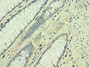 Immunohistochemistry of paraffin-embedded human colon cancer using CAC10654 at dilution of 1:100