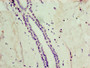 Immunohistochemistry of paraffin-embedded human breast cancer using CAC10660 at dilution of 1:100