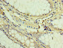 Immunohistochemistry of paraffin-embedded human colon cancer using CAC10662 at dilution of 1:100