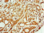Immunohistochemistry of paraffin-embedded human breast cancer using CAC10669 at dilution of 1:100