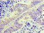 Immunohistochemistry of paraffin-embedded human ovarian cancer using CAC10673 at dilution of 1:100