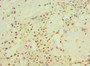 Immunohistochemistry of paraffin-embedded human breast cancer using CAC10678 at dilution of 1:100