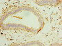 Immunohistochemistry of paraffin-embedded human breast cancer using CAC10687 at dilution of 1:100