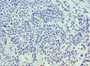 Immunohistochemistry of paraffin-embedded human breast cancer using CAC10690 at dilution of 1:100