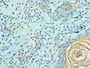 Immunohistochemistry of paraffin-embedded human breast cancer using CAC10696 at dilution of 1:100