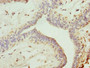 Immunohistochemistry of paraffin-embedded human breast cancer using CAC10702 at dilution of 1:100