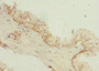 Immunohistochemistry of paraffin-embedded human prostate cancerusing CAC10703 at dilution of 1:100