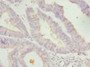 Immunohistochemistry of paraffin-embedded human endometrial cancer using CAC10719 at dilution of 1: 100