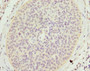 Immunohistochemistry of paraffin-embedded human cervical cancer using CAC10723 at dilution of 1:100