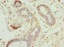 Immunohistochemistry of paraffin-embedded human breast cancer using CAC10734 at dilution of 1:100