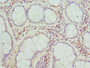 Immunohistochemistry of paraffin-embedded human colon cancer using CAC10739 at dilution of 1:100