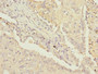 Immunohistochemistry of paraffin-embedded human lung cancer using CAC10750 at dilution of 1:100