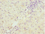 Immunohistochemistry of paraffin-embedded human liver cancer using CAC10761 at dilution of 1:100