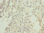 Immunohistochemistry of paraffin-embedded human breast cancer using CAC10771 at dilution of 1:100