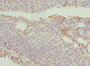 Immunohistochemistry of paraffin-embedded human bladder cancer using CAC10778 at dilution of 1:100