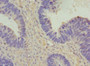 Immunohistochemistry of paraffin-embedded human ovarian cancer using CAC10780 at dilution of 1:100