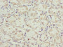 Immunohistochemistry of paraffin-embedded human gastric cancer using CAC10781 at dilution of 1:100
