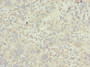Immunohistochemistry of paraffin-embedded human bladder cancer using CAC10782 at dilution of 1:100