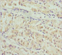 Immunohistochemistry of paraffin-embedded human gastric cancer using CAC10799 at dilution of 1:100