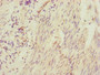 Immunohistochemistry of paraffin-embedded human bladder cancer using CAC10810 at dilution of 1:100