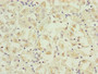 Immunohistochemistry of paraffin-embedded human gastric cancer using CAC10817 at dilution of 1:100