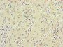 Immunohistochemistry of paraffin-embedded human liver cancer using CAC10832 at dilution of 1:100