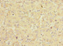 Immunohistochemistry of paraffin-embedded human liver cancer using CAC10843 at dilution of 1:100