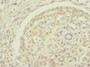 Immunohistochemistry of paraffin-embedded human pancreatic cancer using CAC10858 at dilution of 1:100