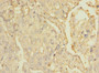 Immunohistochemistry of paraffin-embedded human lung cancer using CAC10867 at dilution of 1:100