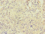 Immunohistochemistry of paraffin-embedded human liver cancer using CAC10874 at dilution of 1:100