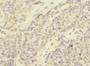 Immunohistochemistry of paraffin-embedded human ovarian cancer using CAC10876 at dilution of 1:100