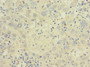 Immunohistochemistry of paraffin-embedded human liver cancer using CAC10883 at dilution of 1:100