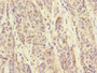 Immunohistochemistry of paraffin-embedded human ovarian cancer using CAC10889 at dilution of 1:100