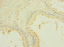 Immunohistochemistry of paraffin-embedded human prostate cancer using CAC10899 at dilution of 1:100